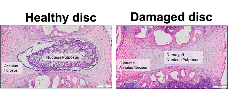 slides comparing a healthy disc and a damaged disc