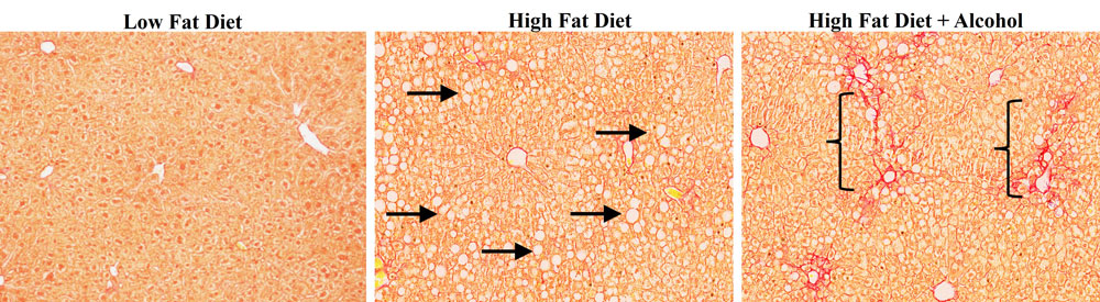 Three microscopic images of liver tissue compare effects of diet: the low-fat sample appears uniform, the high-fat sample shows fat deposits indicated by arrows, and the high-fat plus alcohol sample displays more extensive cell damage marked by brackets.